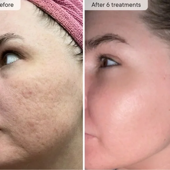 Micro-Infusion Facial System - Qure 2 month supply. Dark spot serum. See descr - Picture 4 of 4